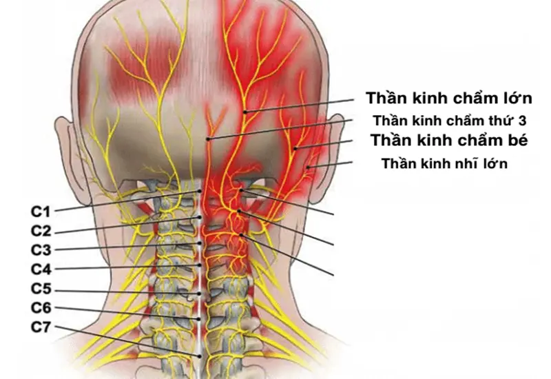 Thoái hóa đốt sống cổ chèn dây thần kinh chẩm gây đau đầu, hoa mắt, chóng mặt.webp